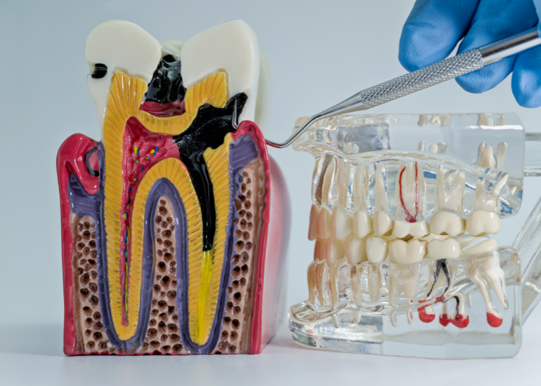 Root Canal Treatment